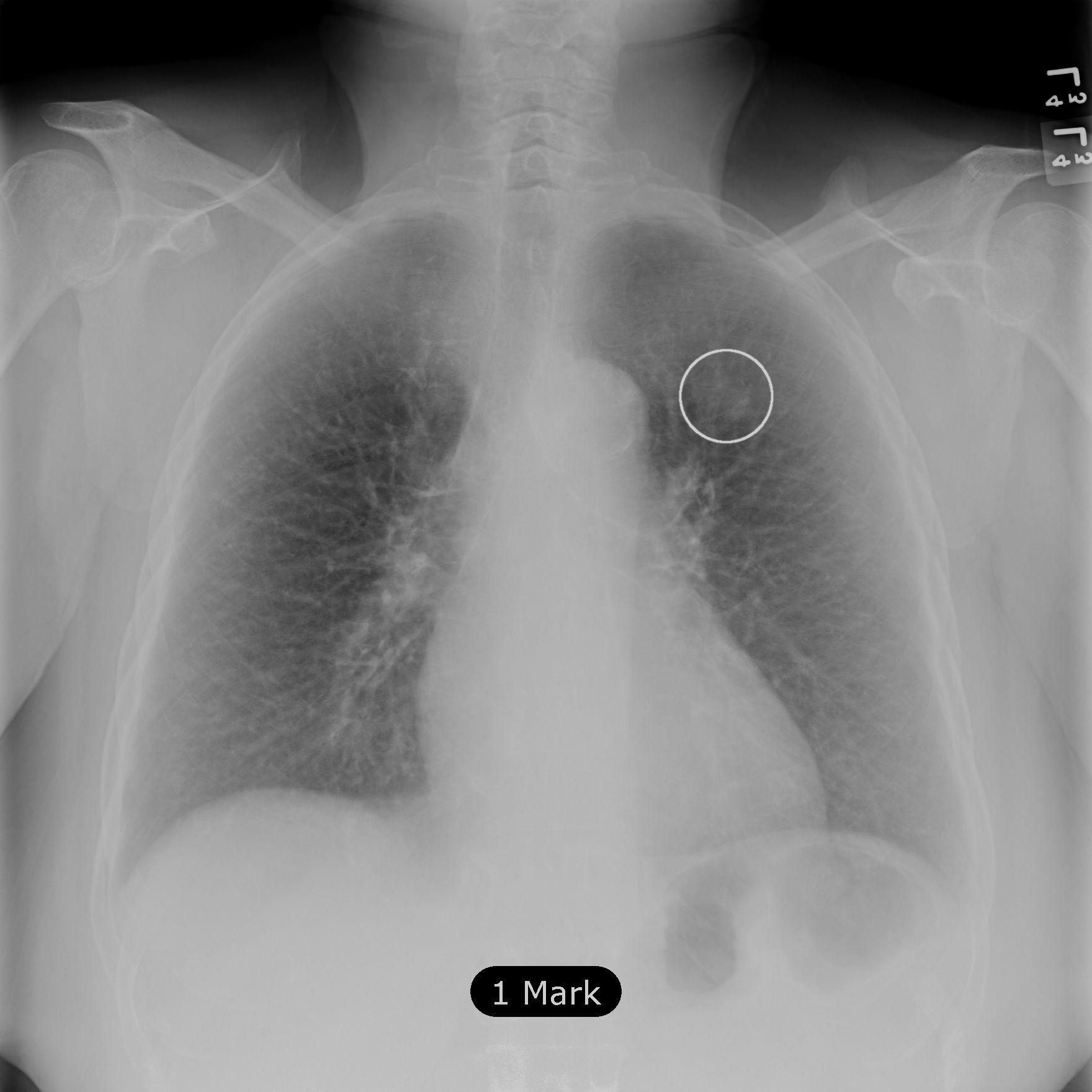 Can chest x ray detect lung cancer