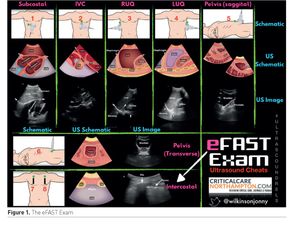 Pdf Overview Of Point Of Care Abdominal Ultrasound In Emergency And ...