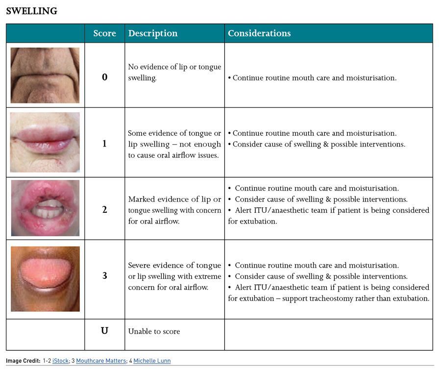 Mouth Care Challenges and the Use of the COVID-19 Oral Grading System ...