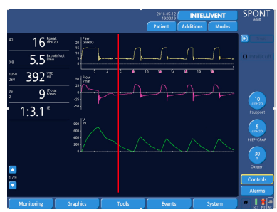 How To Improve Patient-ventilator Synchrony. Waveform Analysis And 