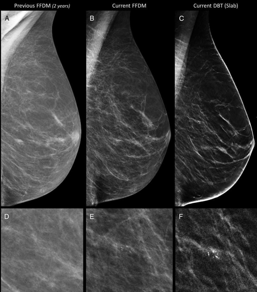 breast cancer digital mammogram