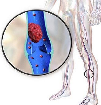 Deep vein thrombosis Deep vein thrombosis
