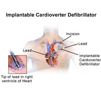 Implantable Cardioverter Defibrillators Underused Among Older Patients HealthManagement Org