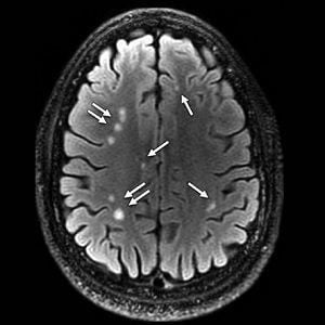 brain scan showing multiple white matter T2-weighted hyperintense areas (arrows) brain scan showing multiple white matter T2-weighted hyperintense areas (arrows)