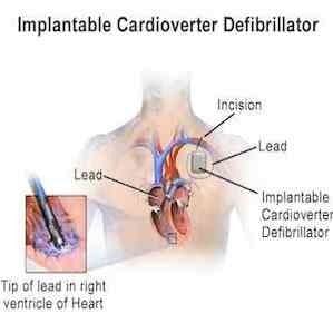 Study - Patient Experience With Implantable Cardioverter Defibrillator 