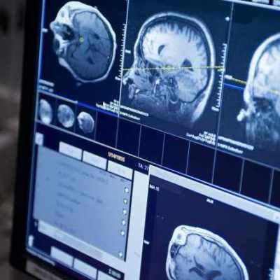 Radiation Chemo Combo Prolongs Survival in Low-Grade Brain Tumour