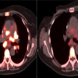 Left image: Pre-therapy; Right image: Three days after treatment Left image: Pre-therapy; Right image: Three days after treatment