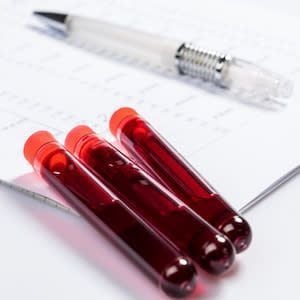 Pancreatic Stone Protein Testing Reduces Expenditure in Sepsis