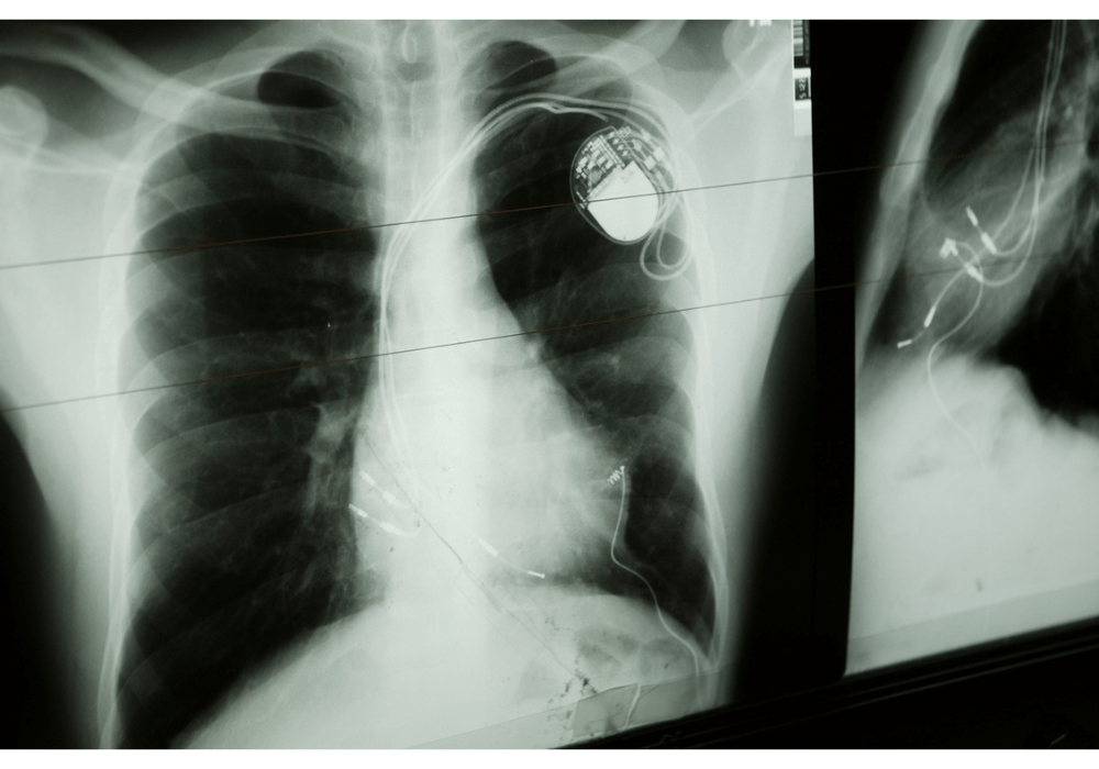 The Silent Threat: Cybersecurity Risks of Implanted Medical Devices