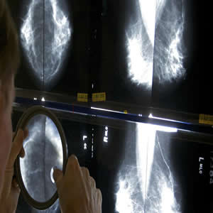 USPSTF New Mammography Guidelines Could Cost Thousands of Lives ...