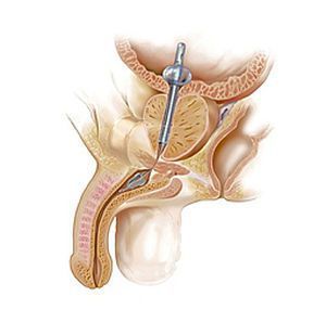 Prostatic stent THE SPANNER™ SRS Medical