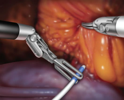 Intraoperative doppler probe (for minimally invasive robotic surgery) Drop-In Vascular Technology