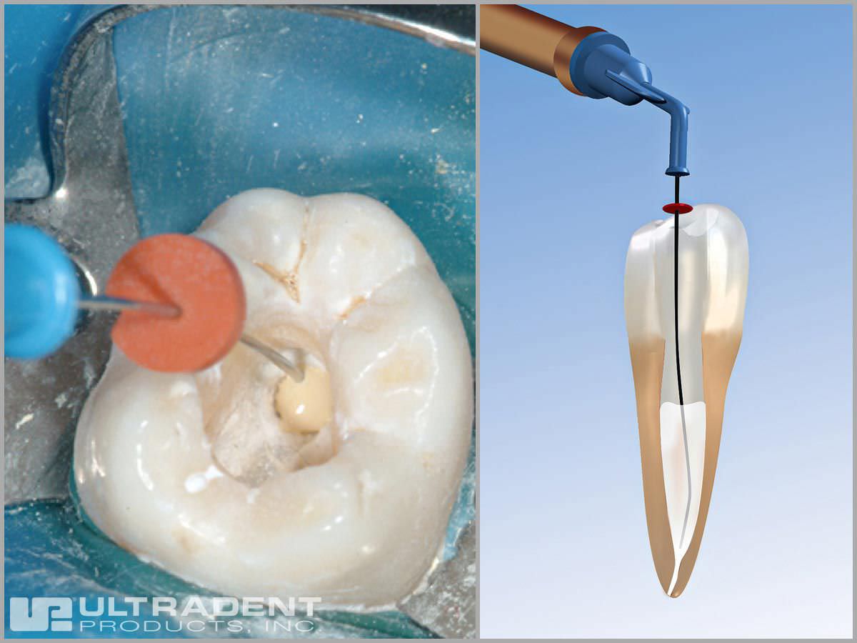 Endodontic irrigation cannula / rigid / flexible NaviTip® series Ultradent Products, Inc. USA