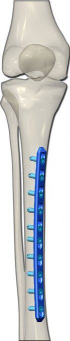 Tibia compression bone plate / medial TST R. Medical Devices