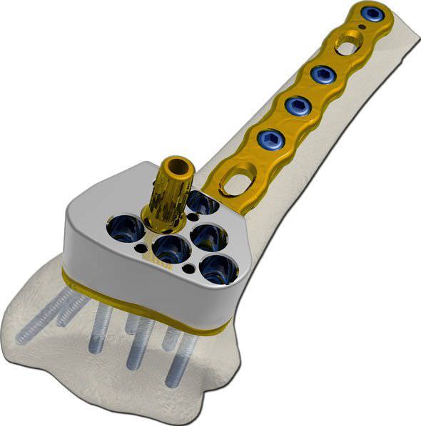 Radius compression bone plate / distal TST R. Medical Devices