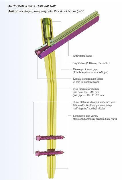 Human intramedullary nail / femur A-PFN TST R. Medical Devices