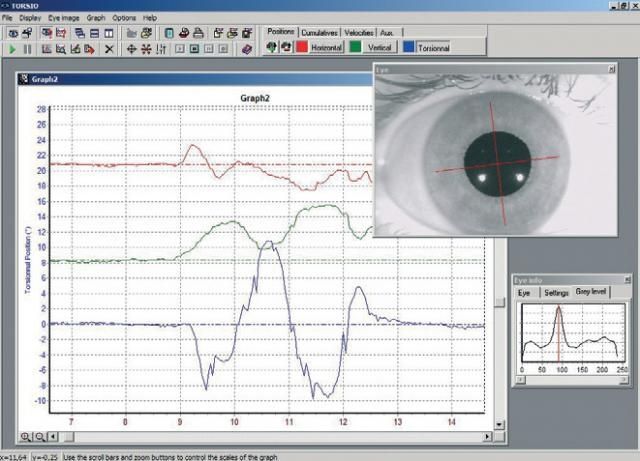 Eye motion analysis software / medical TORSIO ULMER SYNAPSYS