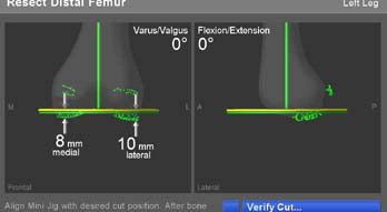 Surgical navigation software / medical / for knee surgery eNdtrac ASM Stryker