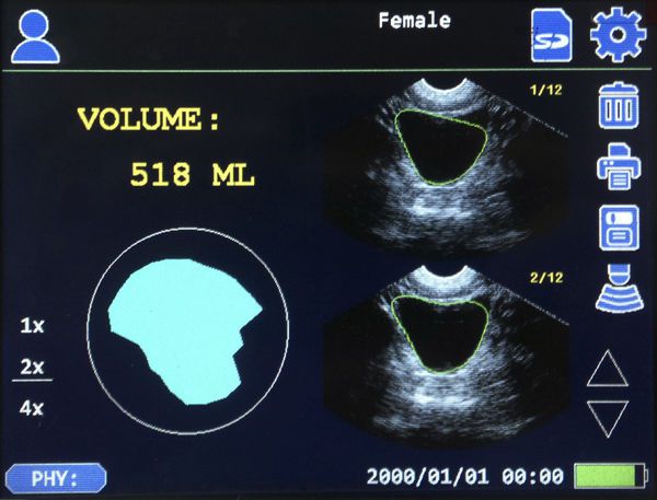 Portable ultrasound bladder scanner CareScan-1 Sonostar Technologies