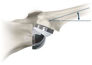 Inverted total shoulder prosthesis / revision / cementless Aequalis Ascend™ Flex Tornier