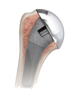 Traditional total shoulder prosthesis / cementless Aequalis Ascend™ Flex Tornier