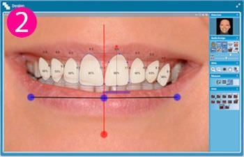 Digital smile design software / dental Planmeca Romexis® Smile Design Planmeca
