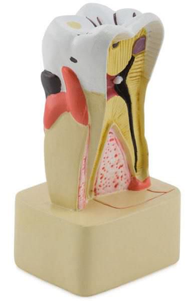 Tooth pathology anatomical model 6041.71 Altay Scientific