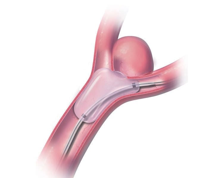 Occlusion catheter / balloon / double-lumen HyperForm™ Covidien