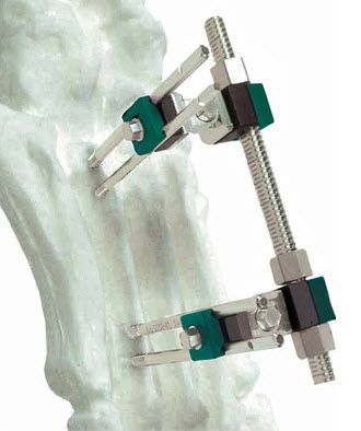 Human external fixation system / tarsal bones SIDEKICK Wright Medical Technology