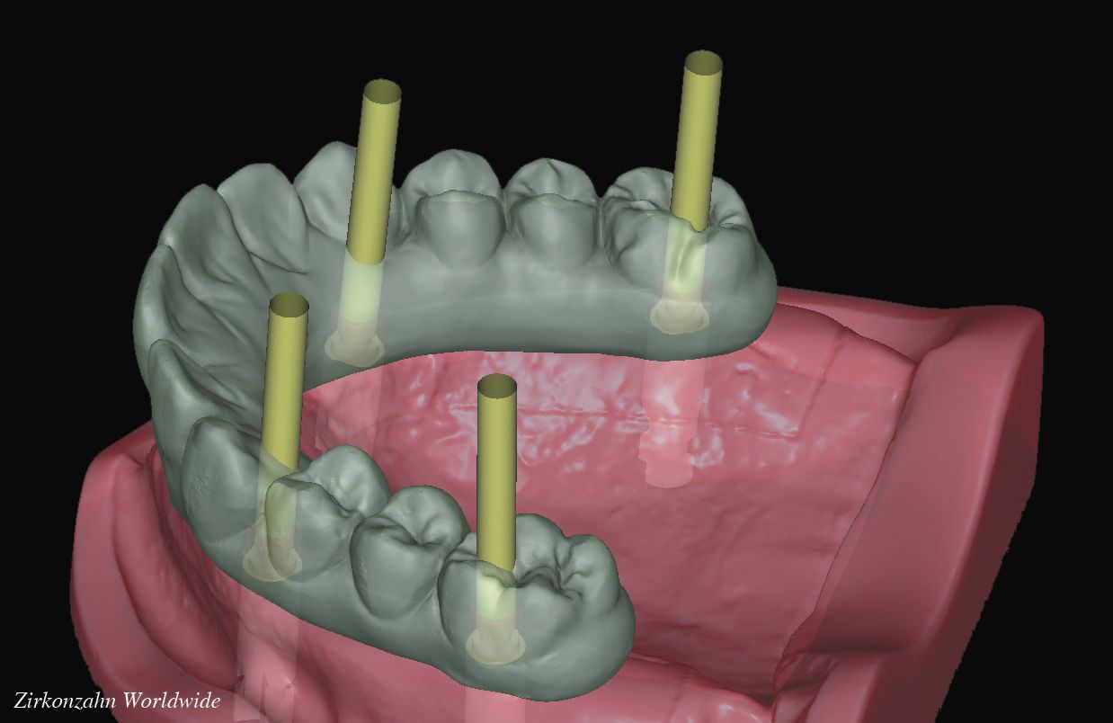 CAD software / CAM / dental laboratory / for implantology Zirkonzahn