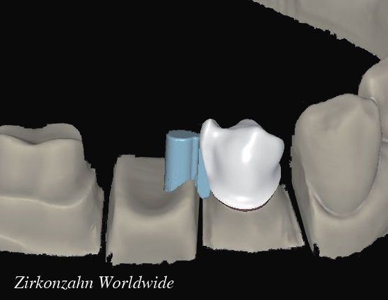 Dental prosthesis design software / CAD / CAM / dental laboratory Attachments Zirkonzahn