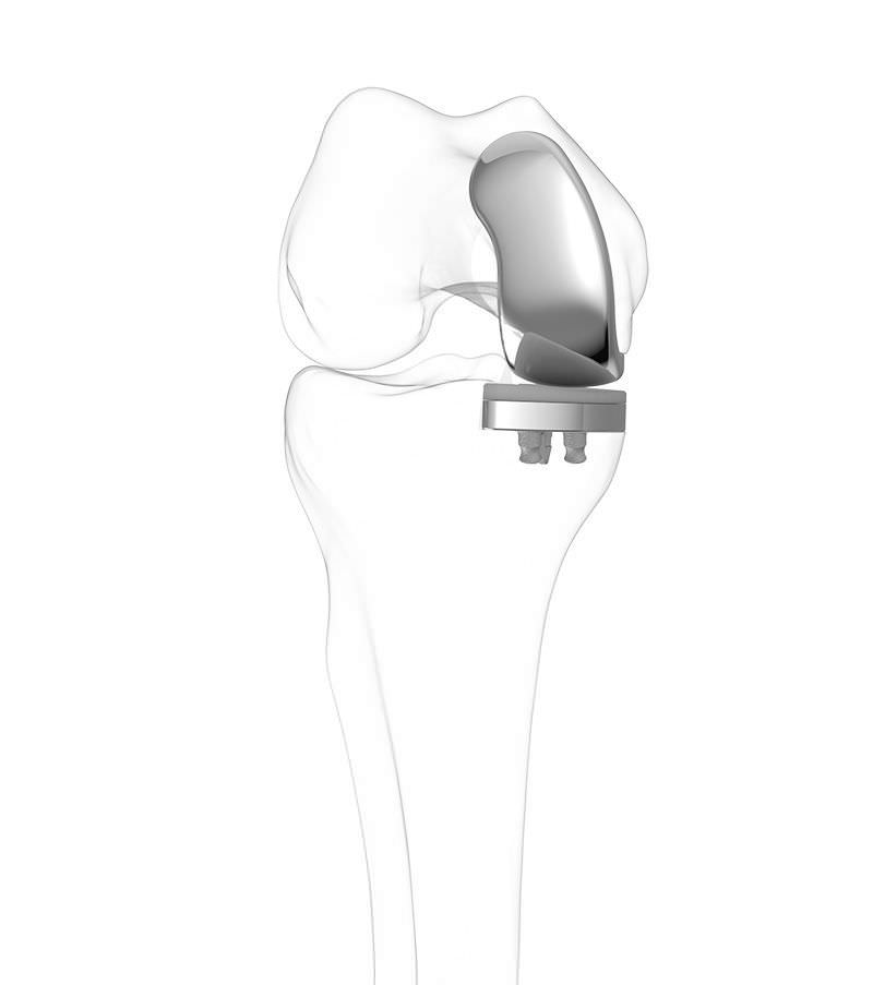 Unicompartmental knee prosthesis / traditional / cemented iUni® G2 ConforMIS