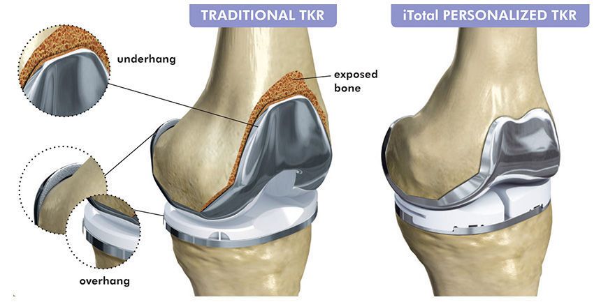 Three-compartment knee prosthesis / traditional / cemented iTotal® G2 ConforMIS
