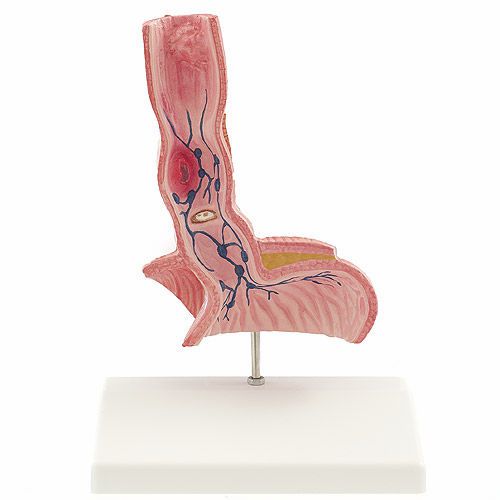 Oesophagus pathology anatomical model NetMed