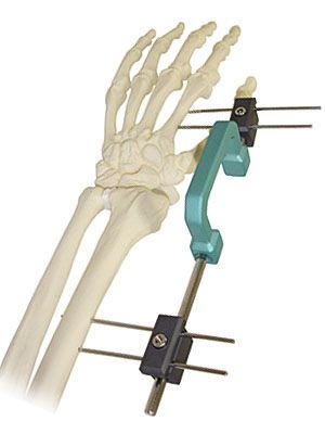 Human external fixation system / wrist CROMUS BAUMER