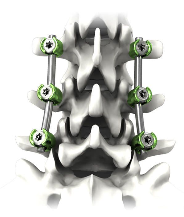 Thoraco-lumbar spinal osteosynthesis unit / posterior NAUTILUS® Life Spine