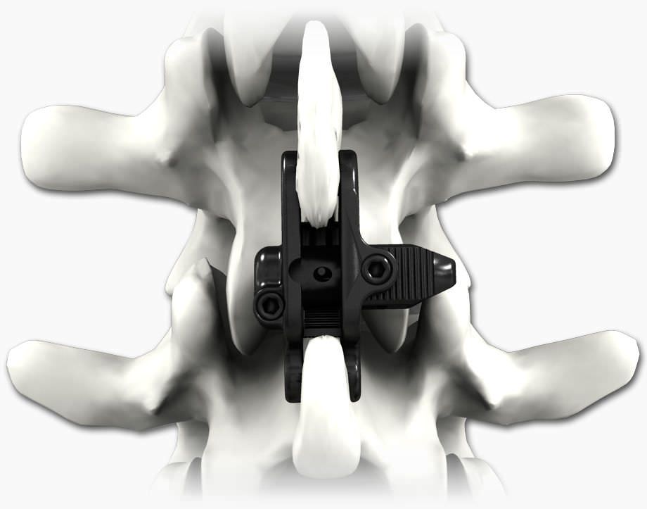 Interspinous vertebral implant AILERON® Expendable Life Spine