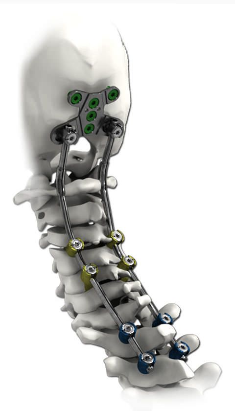 Occipito-cervico-thoracic spinal osteosynthesis unit / posterior SOLSTICE® Life Spine