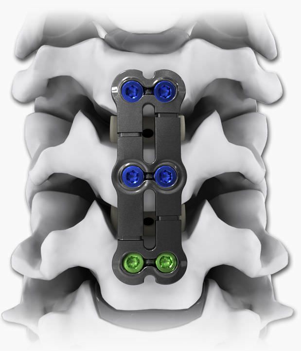 Cervical arthrodesis plate / anterior / 2 levels KINETIC®-SL Life Spine