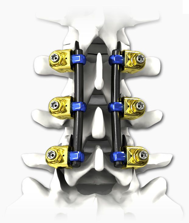Thoraco-lumbar spinal osteosynthesis unit / thoracic / lumbar / posterior PILOT® Life Spine