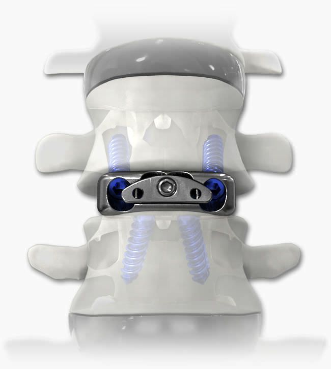 Cervical interbody fusion cage / anterior DYNA-LINK® Life Spine