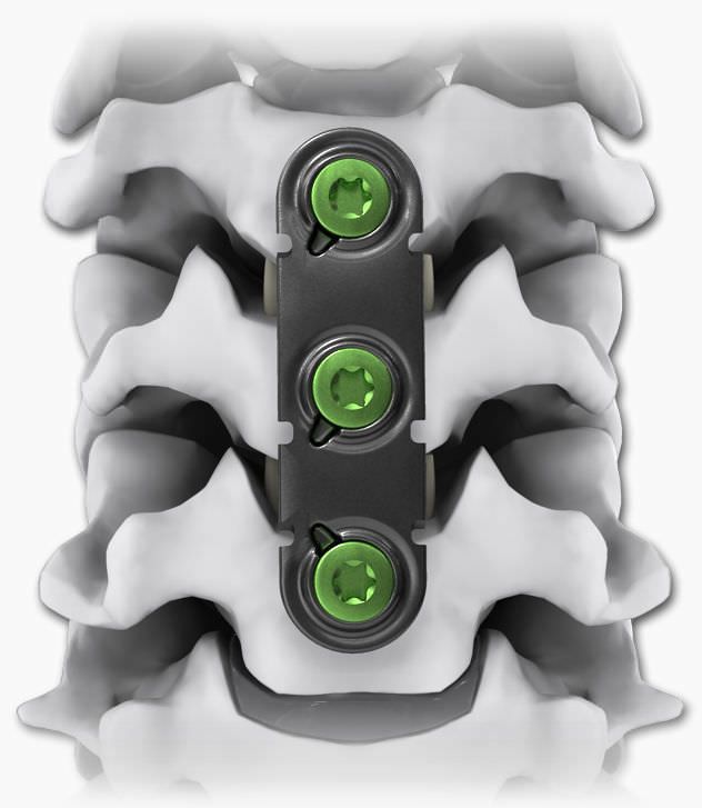 Cervical arthrodesis plate / anterior / 2 levels NEO®-UL Life Spine