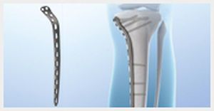 Humerus compression bone plate / medial Reindeer™ Shanghai Microport Orthopedics Co.,Ltd