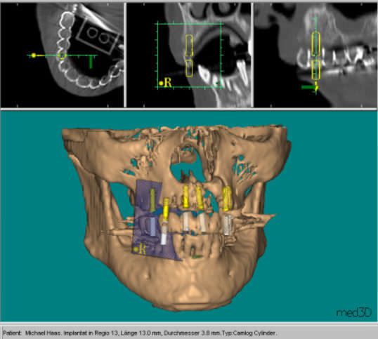 Dental implant simulation software / 3D simulation / preoperative planning / for dental imaging IMPLANT3D med3D