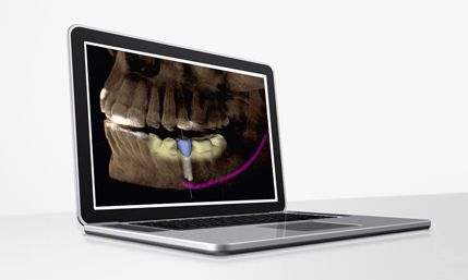 Dental implant simulation software / planning / for implantology CEREC SIRONA France