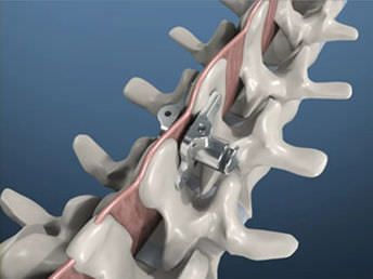 Interspinous vertebral implant PITBULL® BM Korea