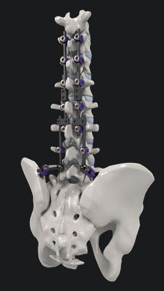 Lumbo-sacral spinal osteosynthesis unit / posterior SYNSTER® DOMINO BM Korea