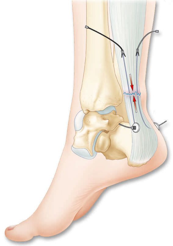 Calcaneal tendon ligament prosthesis / synthetic TENOLIG FH Orthopedics