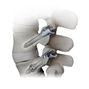 Monoaxial pedicle screw OSSEOSCREW® Alphatec Spine