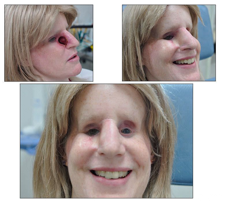 Nasal external cosmetic prosthesis RealLifeSkin™ RealLifeSkin
